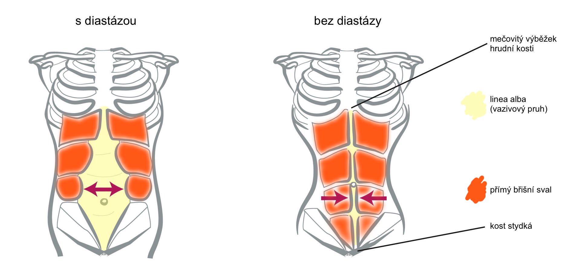 Jak bolí diastáza?